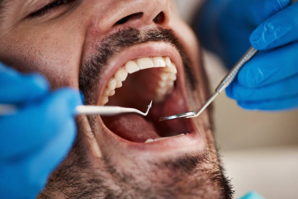 Best Emergency Dental Care for Broken or Chipped Teeth in Greenport West, NY